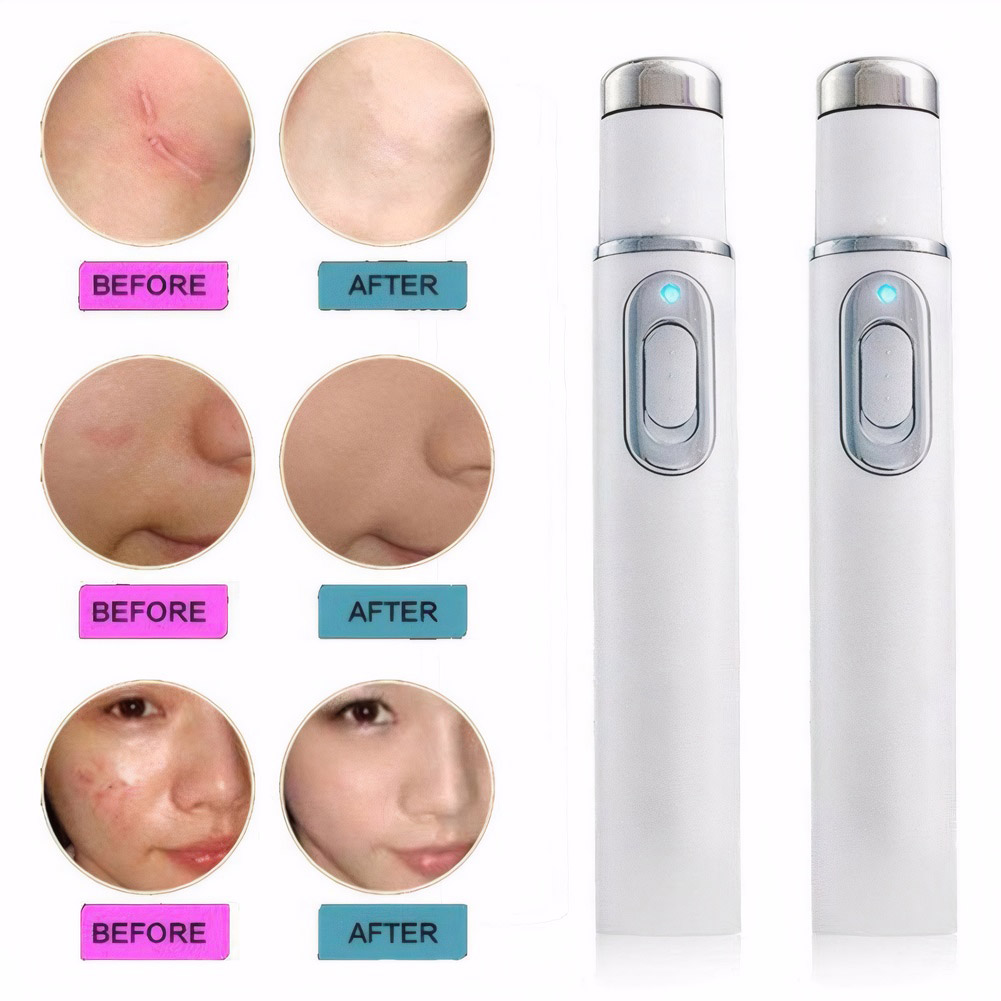 Terapia della luce blu Penna p - Acne Light Therapy Pen recensione e prezzo
